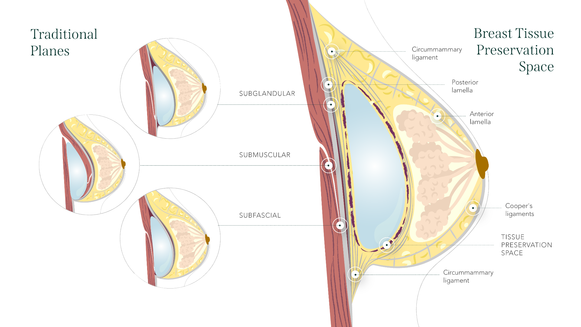 Planos tradicionales vs. Breast Tissue Preservation Space